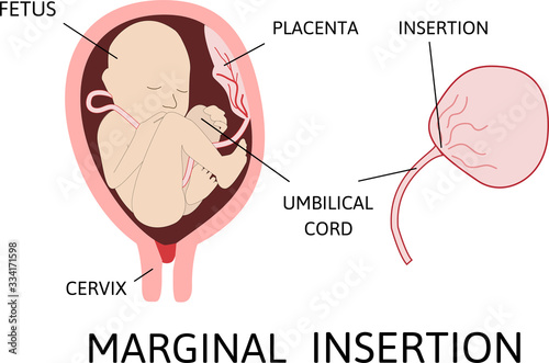 Marginal insertion of umbilical cord. insertion site varies