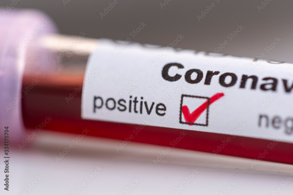 Obraz premium Blood sample for coronavirus testing
