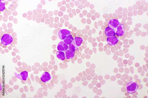Acute promyelocytic leukemia cells or APL, analyze by microscope, original magnification 1000x photo