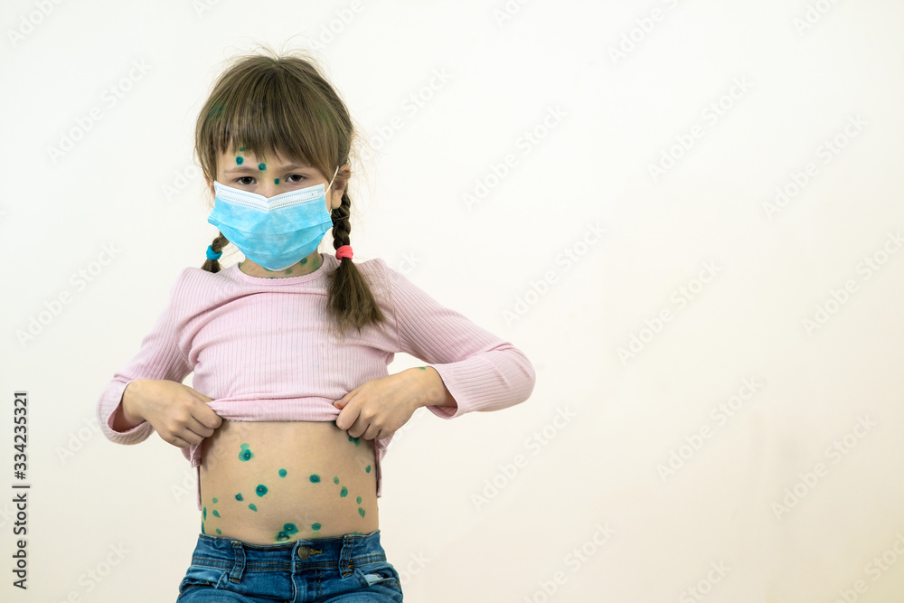 Child girl wearing blue protective medical mask ill with chickenpox, measles or rubella virus with rashes on body. Children protection during epidemic of coronovirus. Covid-19 contagion concept. Child girl wearing blue protective medical mask ill with chickenpox, measles or rubella virus with rashes on body. Children protection during epidemic of coronovirus. Covid-19 contagion concept.