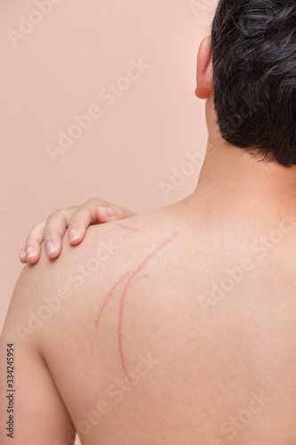 scar scratch on man back in accident injury hand touch back pain