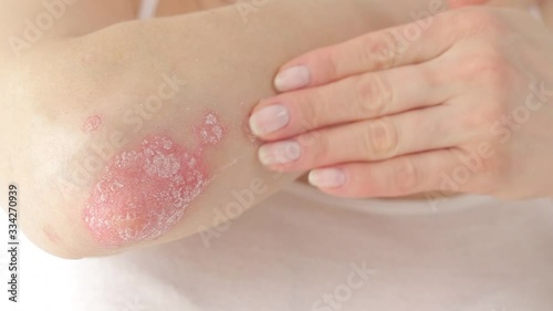 Woman applying anti-inflammatory medicine for corticosteroids for psoriasis. Application of a therapeutic ointment to calm the plurito on the elbow.Treatment of skin diseases - psoriasis, eczema photo