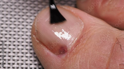 Application of nail solution with brush. Nail infections caused by fungi such as: onychomycosis caused by dermatophytes and yeasts and for the concomitant antibacterial activity. Close up