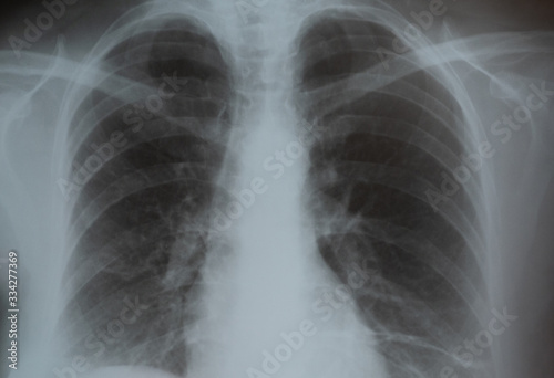 Lungs on X-ray film roentgen, medical background - pneumonia and tuberculosis disease concept photo