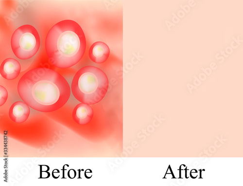 Texture, inflamed pimples and acne. Before After acne cysts. Skin background. Infographics. Vector illustration on isolated background.