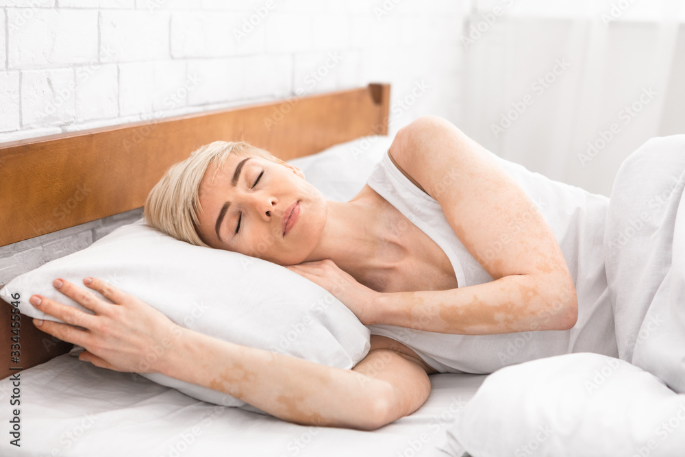 Portrait of mature sleeping lady with vitiligo disease Portrait of mature sleeping lady with vitiligo disease