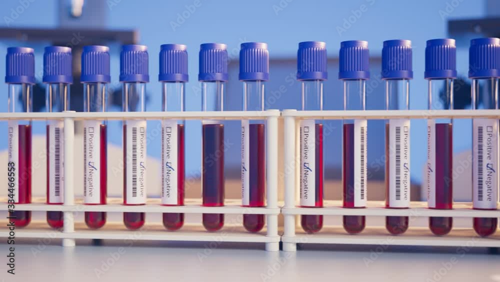 Blood samples for test in the laboratory. Positive probe. Laboratory. Lab 4k HD. Blood samples for test in the laboratory. Positive probe. Laboratory. Lab 4k HD.