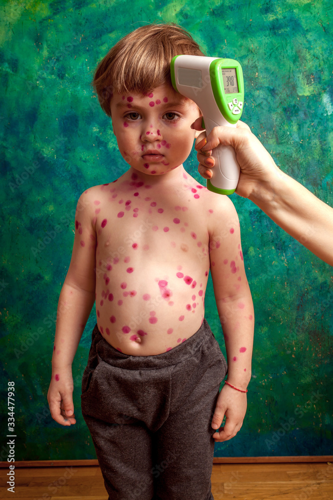 ,boy with chickenpox. Sick child with chickenpox. Varicella virus or