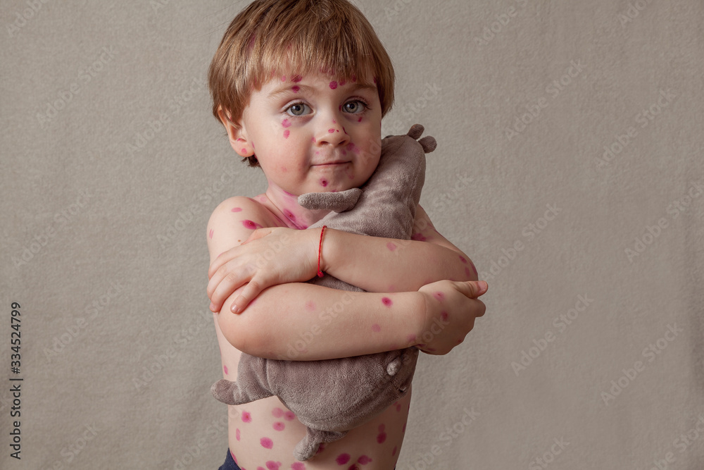 ,boy with chickenpox. Sick child with chickenpox. Varicella virus or