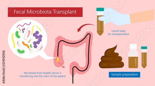 Fecal microbiota transplant (FMT) stool transferring bacteria microbes 