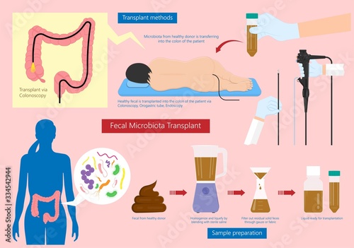Fecal microbiota transplant (FMT) stool transferring bacteria microbes 