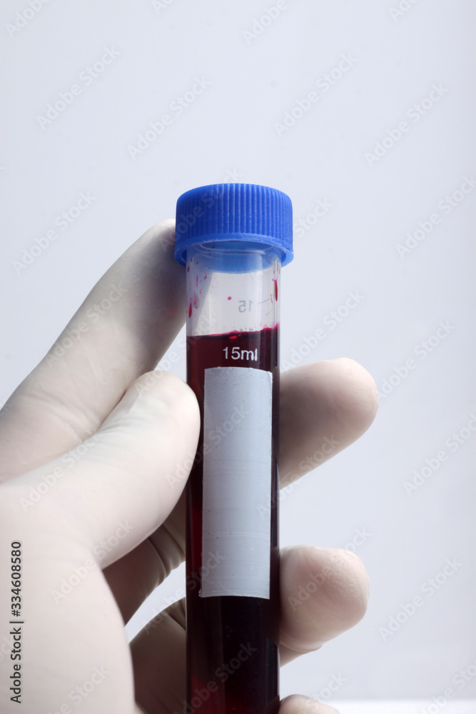 Blood sample from patient placed into test tube for analyzing and testing at laboratoty Blood sample from patient placed into test tube for analyzing and testing at laboratoty