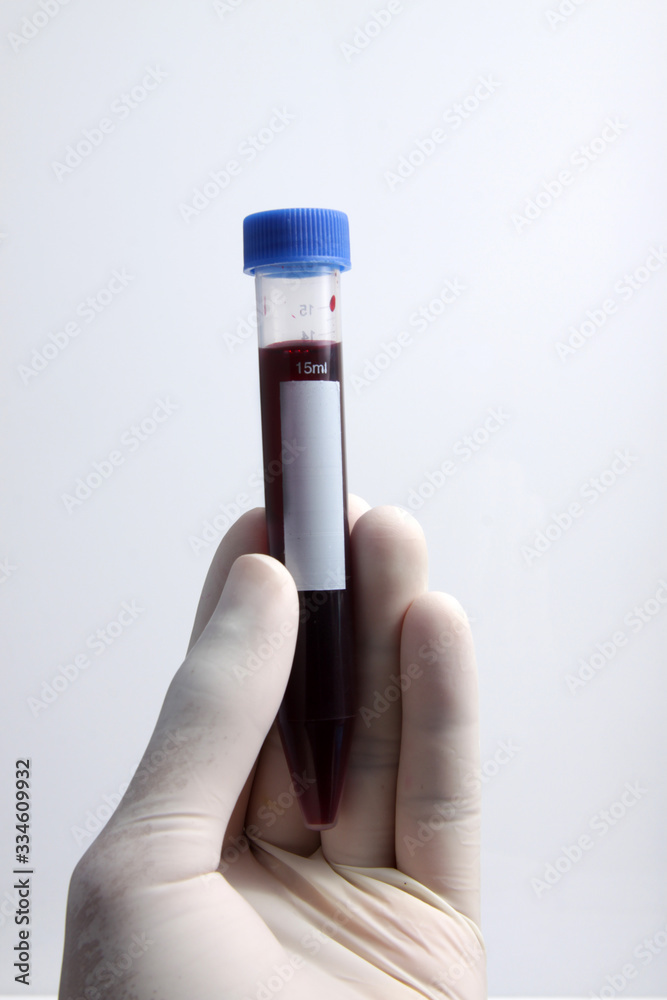 Blood sample from patient placed into test tube for analyzing and testing at laboratoty Blood sample from patient placed into test tube for analyzing and testing at laboratoty