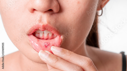 Foto Asian women have aphthous ulcers on mouth on white background, selective focus