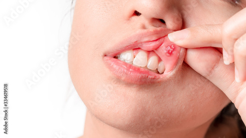 Asian women have aphthous ulcers on mouth on white background, selective focus.