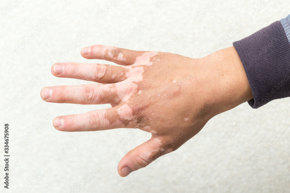 Fototapeta premium holding white spots of vitiligo