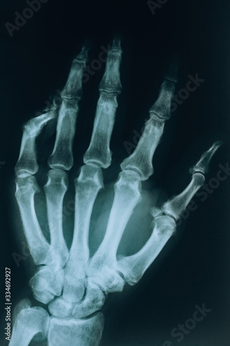 X-ray of the hand. A real x-ray of the human hand, fingers and bones. Finger injury