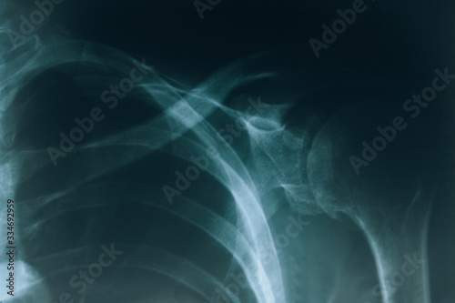 X-ray of the shoulder. Real x-ray picture of the shoulder joint, clavicle broken. Human bones.