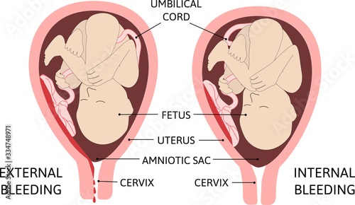 child in the womb. Vaginal bleeding external and internal