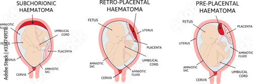 Placental haematoma. blood clots that arise from the placenta. photo