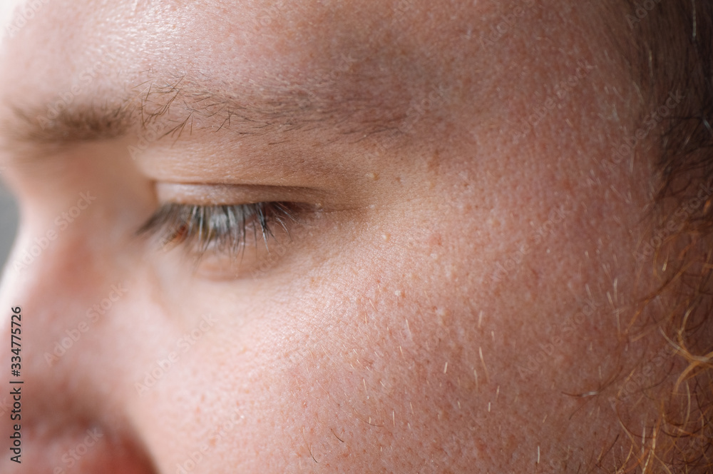 Obraz premium Milia (Milium) - pimples around eye on skin. Eyes of young man with small papillomas on eyelids or growths on skin