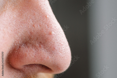 Clogged pores. Problematic skin. Post-acne  scars and red festering pimples on the face of a young man.