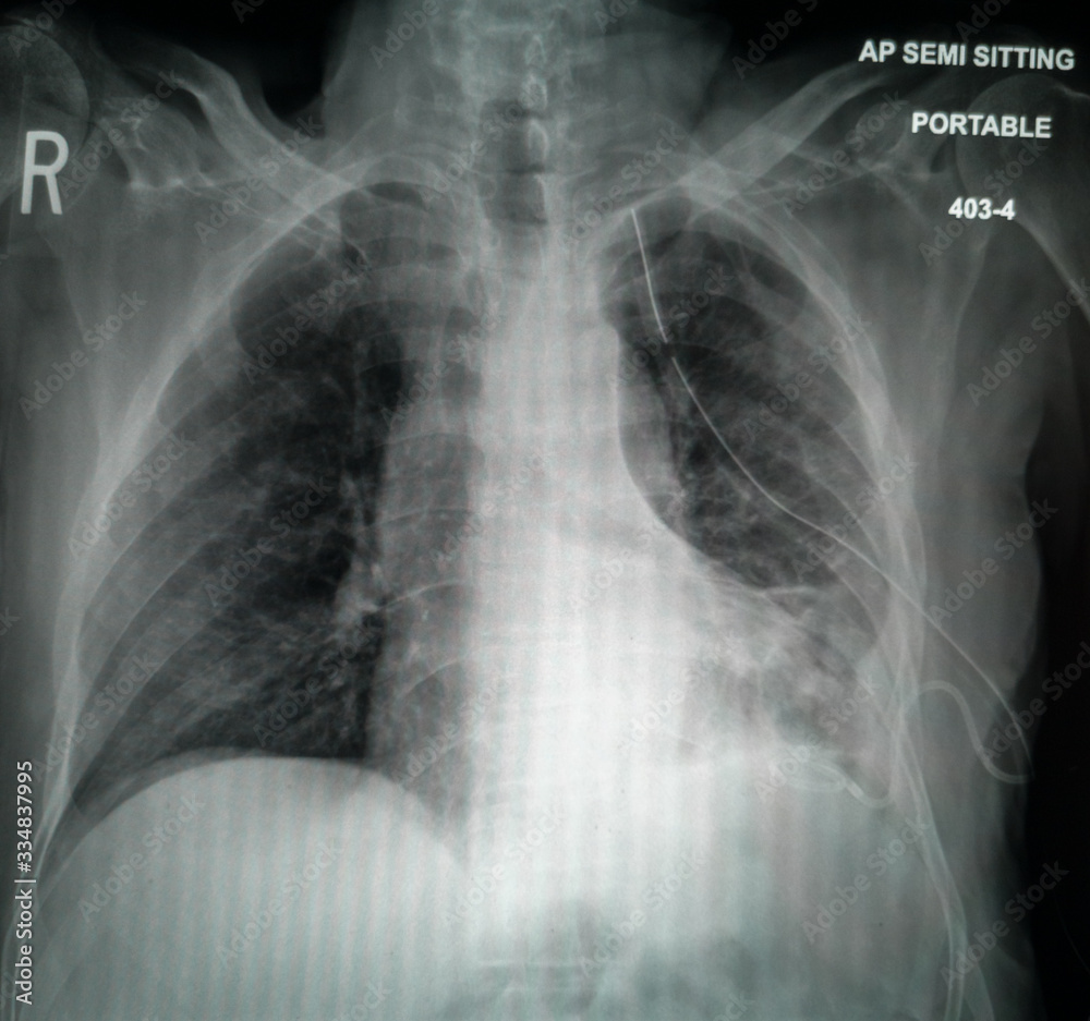 Chest XRay of suspected Corona virus patient high quality image