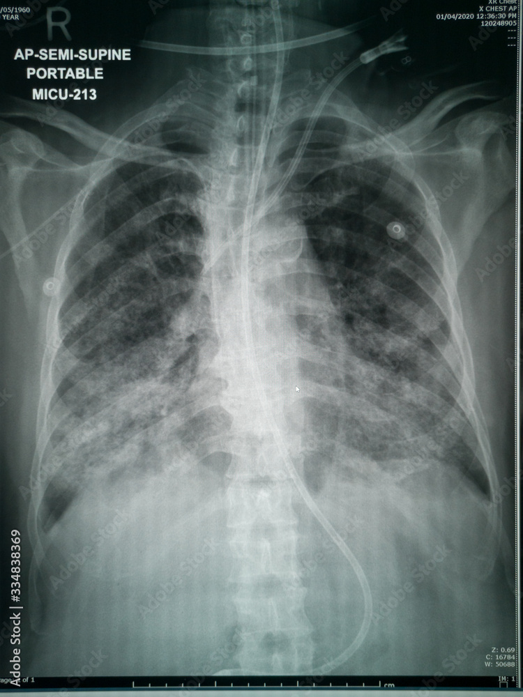 Chest XRay of suspected Corona virus patient high quality image
