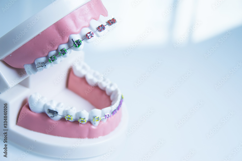 Model denture with metal orthodontics Model denture with metal orthodontics
