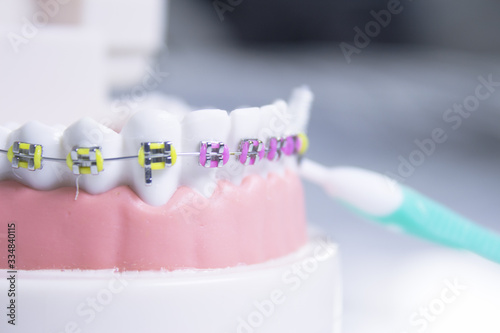 Model denture with metal orthodontics