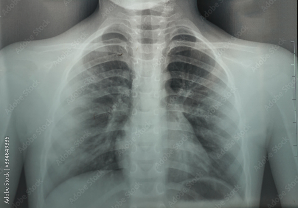 X ray of chest and lungs of young boy. Concept complications from coronavirus, pneumonia X ray of chest and lungs of young boy. Concept complications from coronavirus, pneumonia