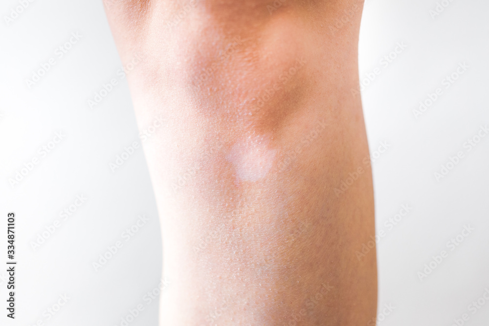 White vitiligo spot on the skin, lack of melanin White vitiligo spot on the skin, lack of melanin