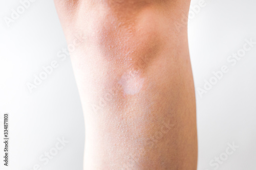 White vitiligo spot on the skin, lack of melanin