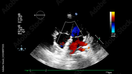 Image of the heart during transesophageal ultrasound with Doppler mode.