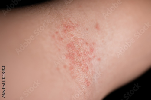 Skin allergic to chemicals causing a rash on the arms, legs, neck and body.