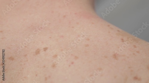 Close-up of large rashes or smallpox on the skin of an adult male. Pigmented spots on the back of a man. Skin of a man with moles. Acne.