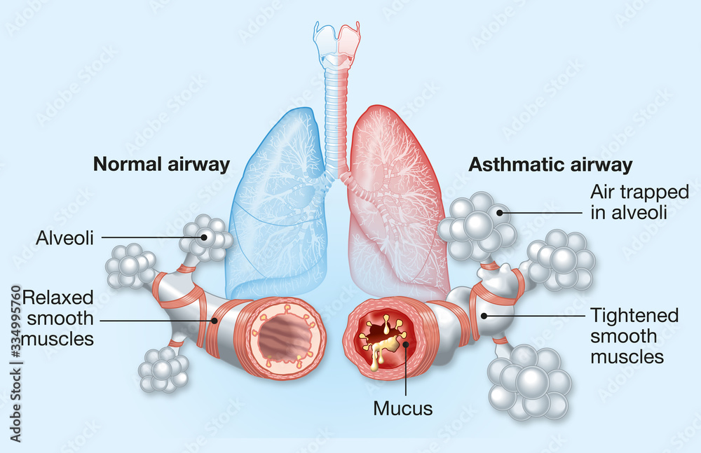 Asthma Normal And Asthmatic Airways Medically Illustration 