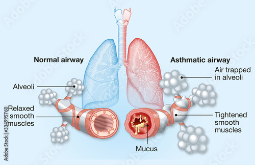 Asthma, normal and asthmatic airways, medically illustration