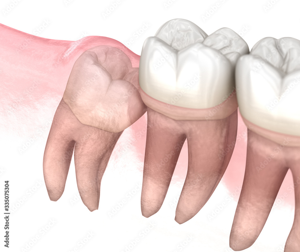 Mesial impaction of Wisdom tooth. Medically accurate tooth 3D ...