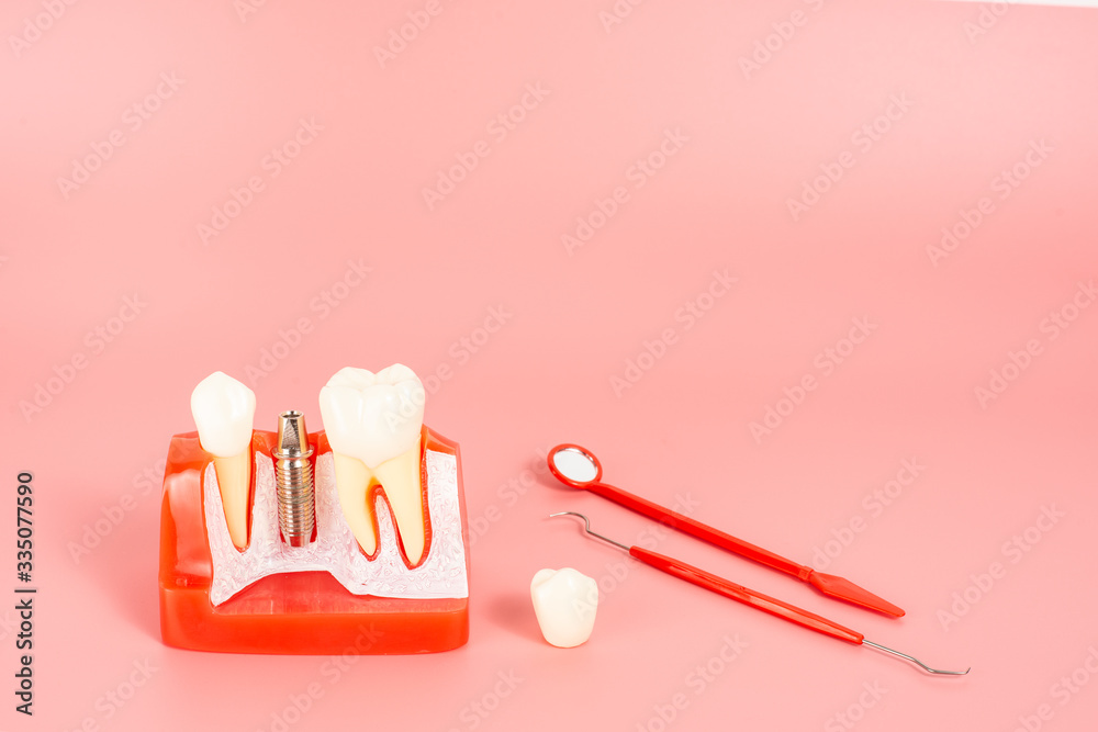 Example of Implants and dental tools for use in explaining. Example of Implants and dental tools for use in explaining.
