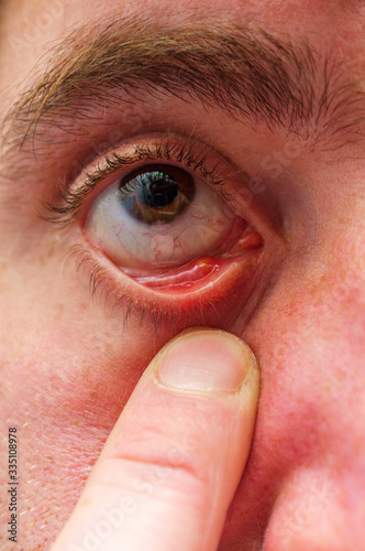 Stye Bacterial Eye Infection photo