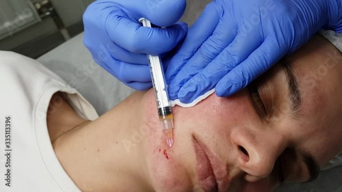 Procedure of plasmolifting to young woman at cosmetology clinic. Injections into the face with plasma taken from the patient’s blood in cheeks, forehead and chin. Skin rejuvenation and rose treatment photo