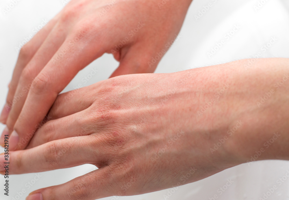 Hands with dry, irritated, and cracked skin Hands with dry, irritated, and cracked skin