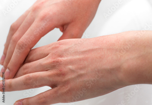 Hands with dry, irritated, and cracked skin