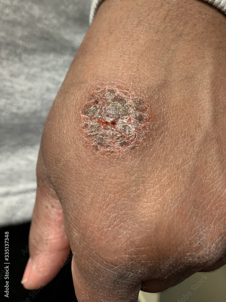 Nummular eczema or nummular dermatitis on african american hand. Round  lesion on skin of black hand. Dermatology disorder Stock Photo | Adobe Stock