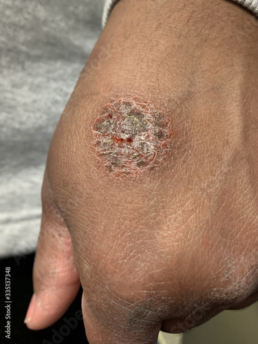 Nummular eczema or nummular dermatitis on african american hand. Round lesion on skin of black hand. Dermatology disorder