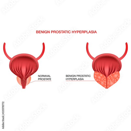 Benign prostatic hyperplasia.Editable vector illustration in realistic style