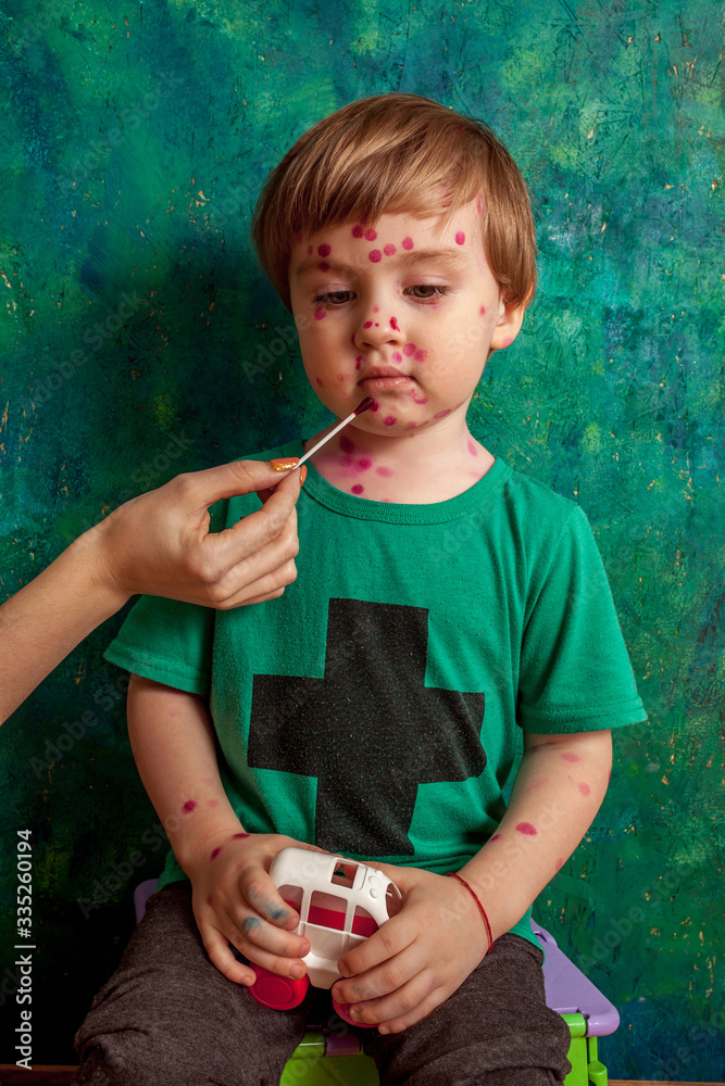 ,boy with chickenpox. Sick child with chickenpox. Varicella virus or