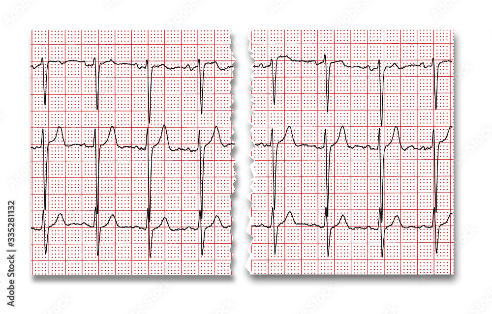 Cardiogram. The result of research CU is torn in half. Cardiogram. The result of research CU is torn in half.