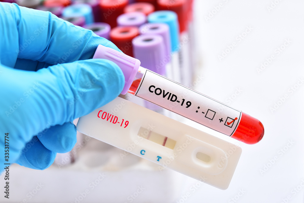 Positive test result by using rapid test device for COVID-19 virus Positive test result by using rapid test device for COVID-19 virus
